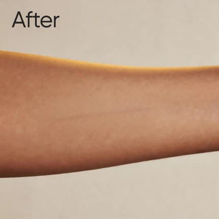 Visible improvement with smoother, clearer skin