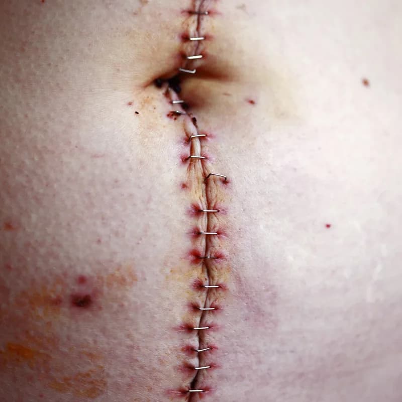 Keloid Scar